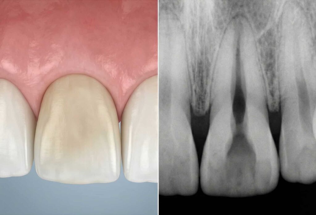 02 Internal inflammatory resorption