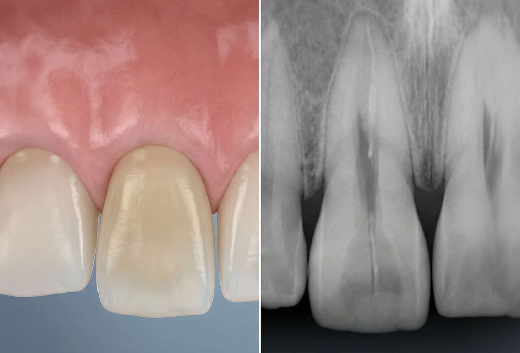 03 External cervical resorption