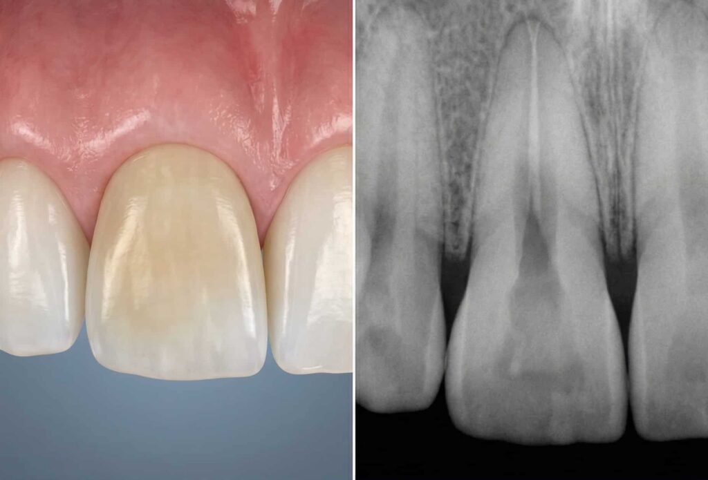04 External replacement resorption ankylosis