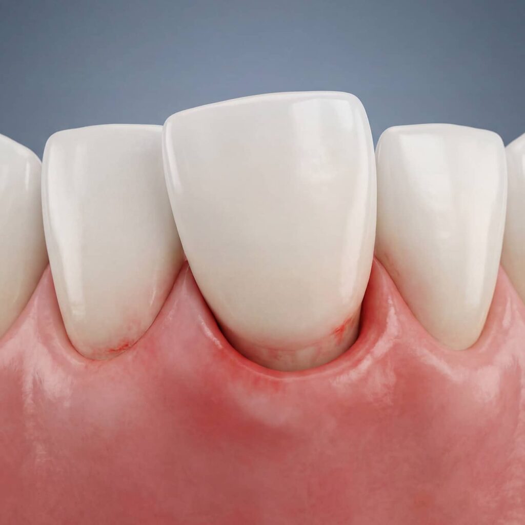 Tooth Luxation Displacement web
